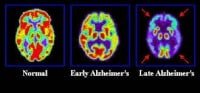 A Vision Of A Future Free Of Alzheimer’s