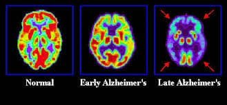 alzheimer's