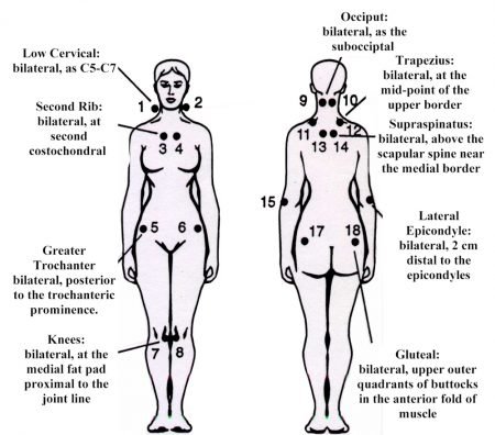 fibromyalgia