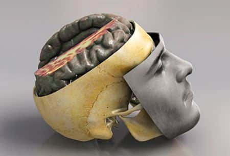 PARKINSON'S