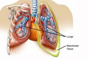 Mesothelioma